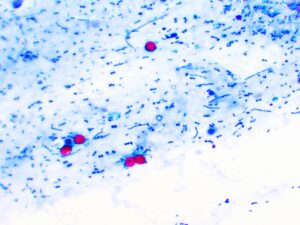 Cryptosporidium parvum protozoa positive (red sphere shape) in human stool smear, oocyst stage, acid-fast stain, analyze by microscope.